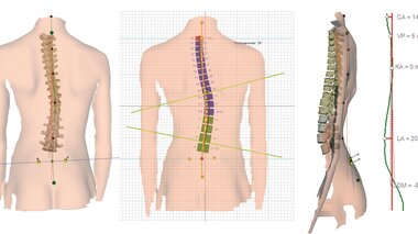 Wirbelsäulenscan | © DIERS